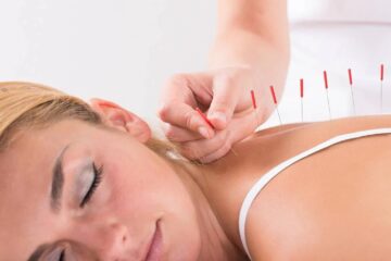 Acupuncture